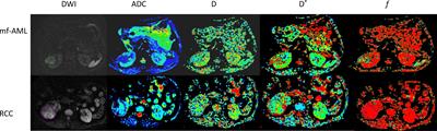 MRI-Based Radiomics and Urine Creatinine for the Differentiation of Renal Angiomyolipoma With Minimal Fat From Renal Cell Carcinoma: A Preliminary Study